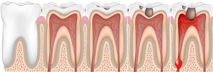 пульпит лечение