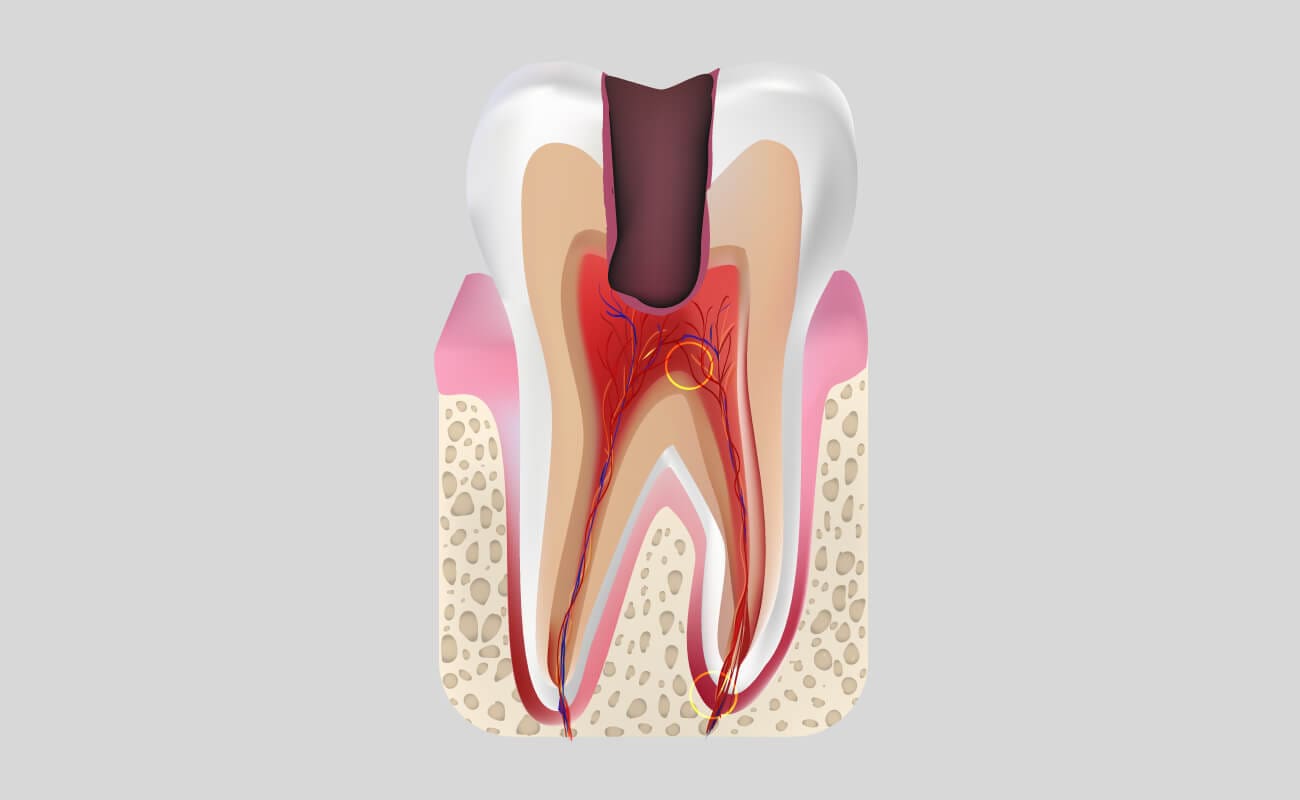 лечение пульпита зуба
