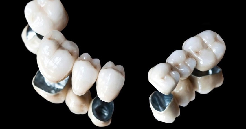 металлокерамические Коронки на зубы