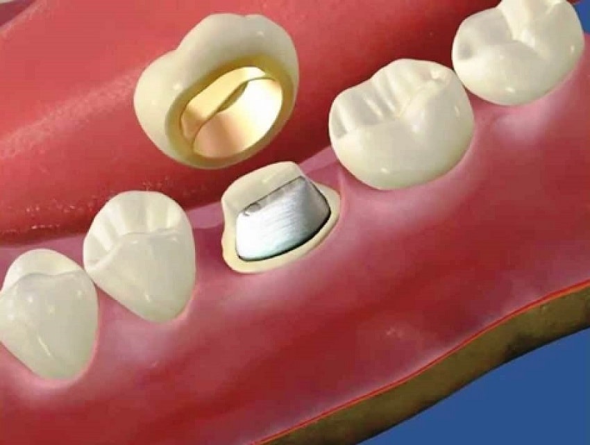 металлокерамические Коронки на зубы
