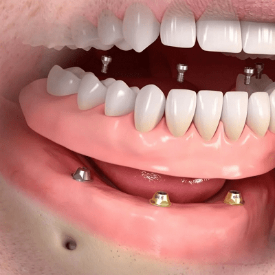 несъемные зубные протезы