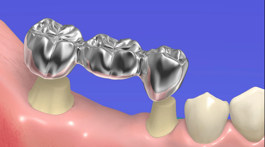 Несъемные протезы зубов из металла
