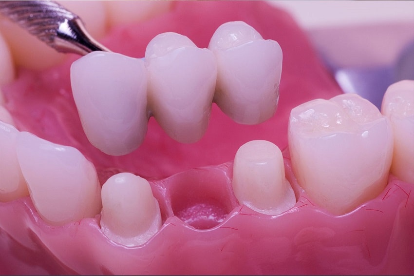 Несъемные протезы зубов из металлокерамики