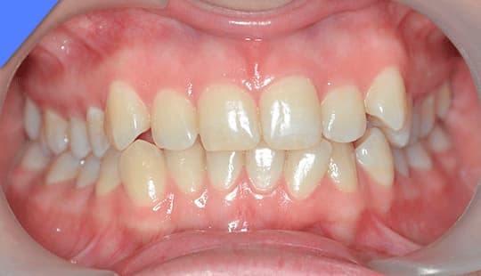 лечение зубов в стоматологии в Мытищах