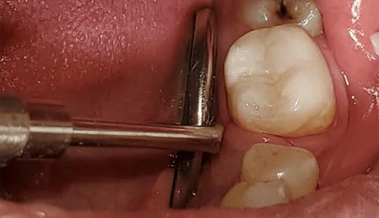 реставрация жевательного зуба