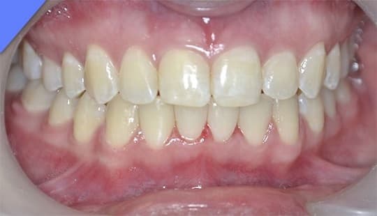 лечение зубов в стоматологии в Мытищах